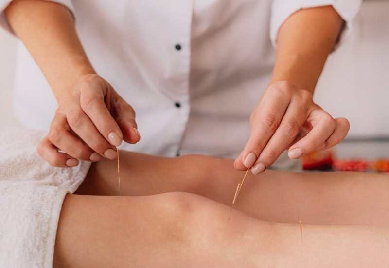 Unlocking Holistic Wellness: The Power of Acupuncture